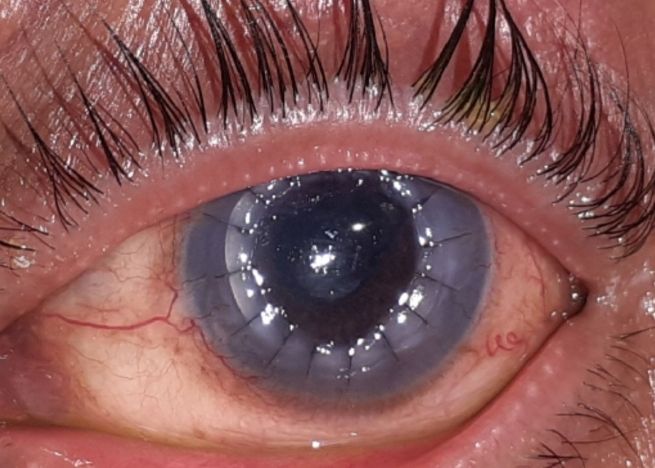 After Keratoplasty