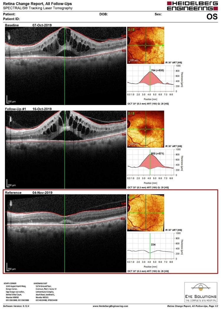 OCT retina before and after injection