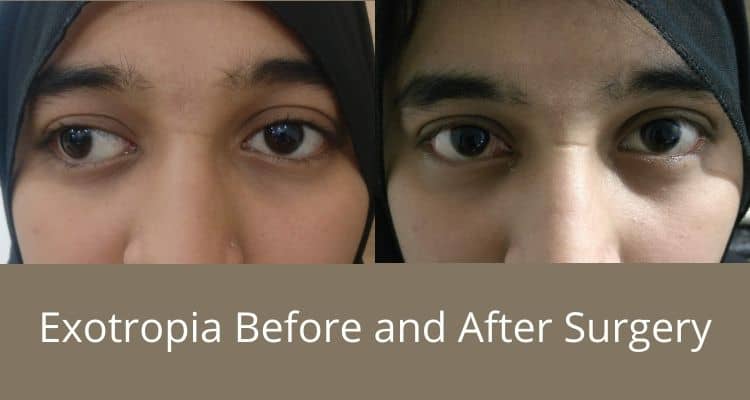 Exotropia before and after surgery