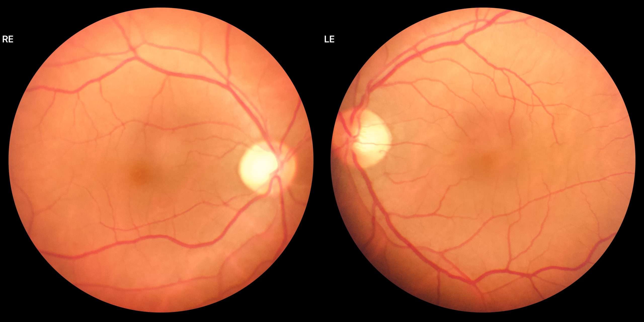 Retina Test, Fundus Checkup, Dilated test, Diabetes in retina