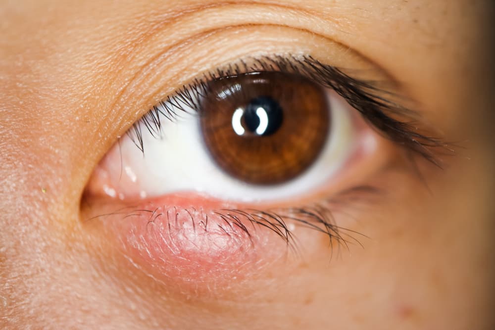 Pimple on lower eyelid hotsell