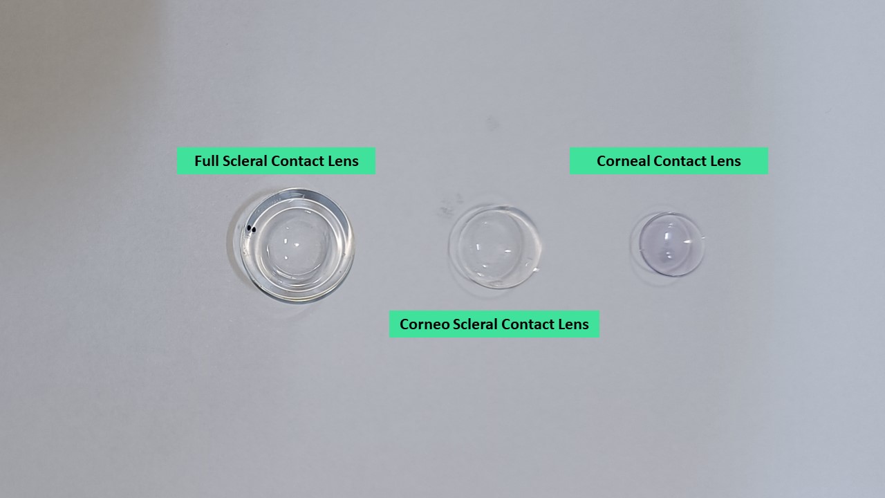 कॉन्टैक्ट लेंस के प्रकार - स्क्लेरल लेंस का व्यास सबसे बड़ा होता है
